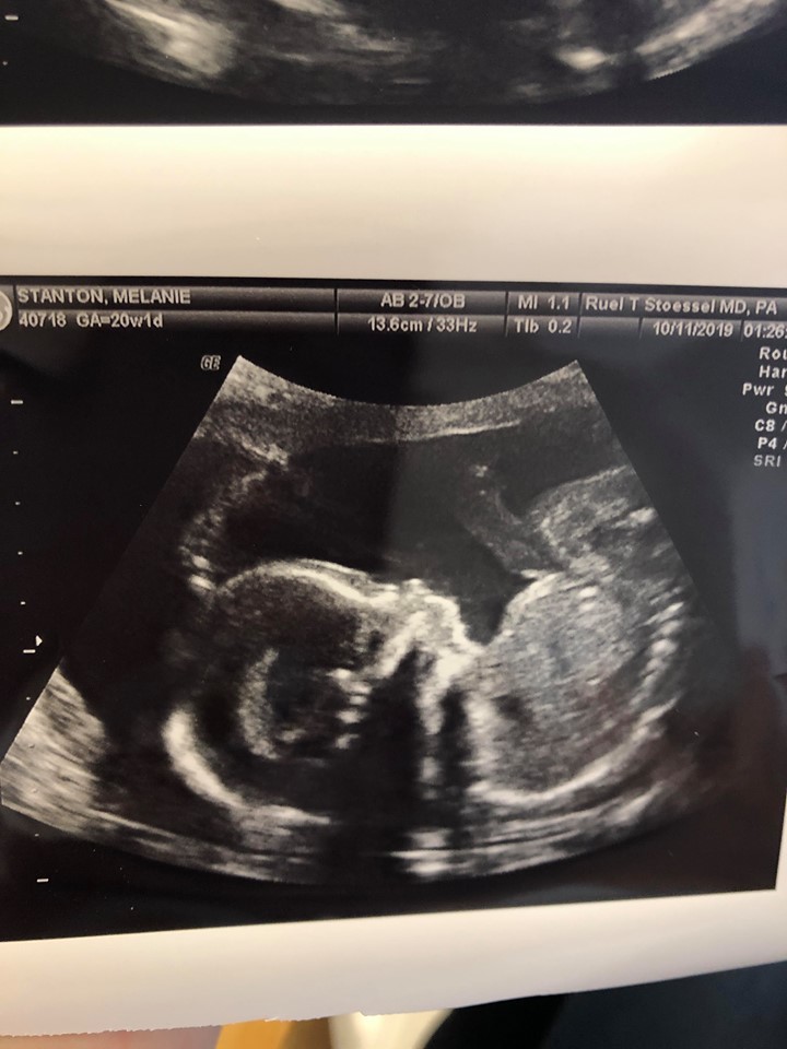 Trimester ultrasound second Second trimester
